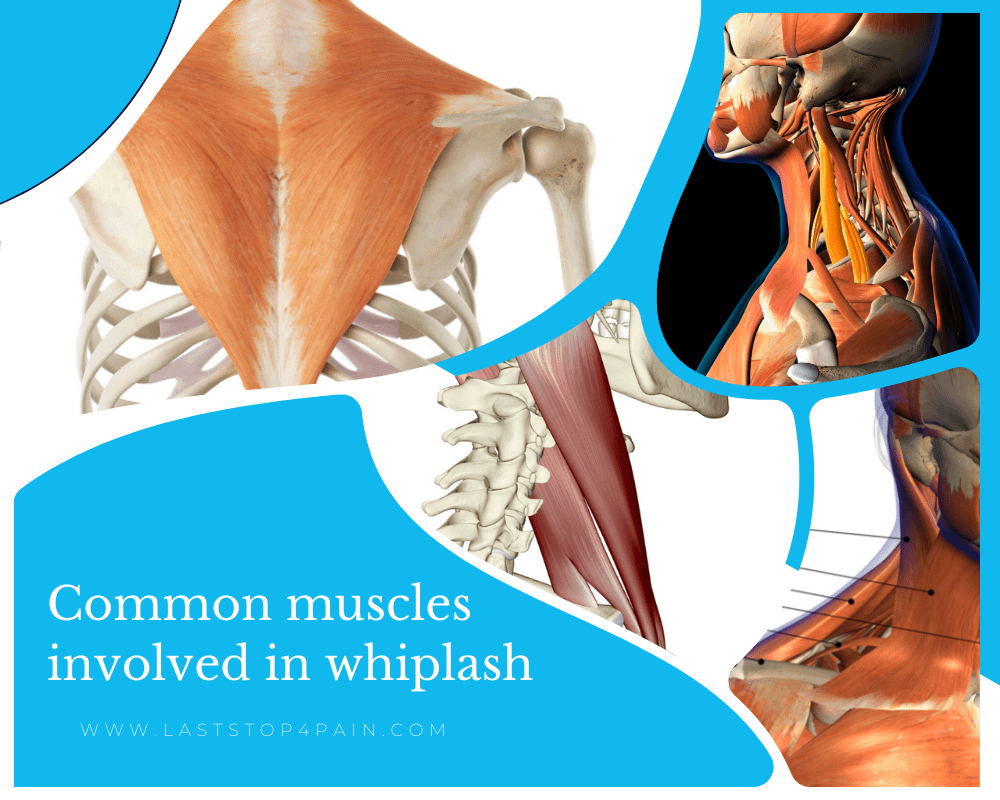 muscles effected by whiplash